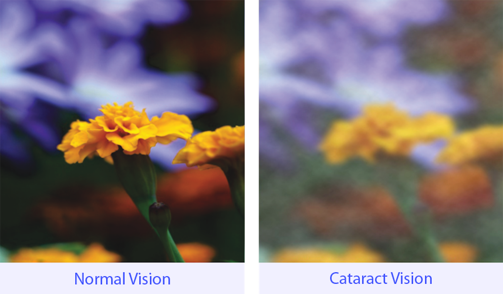 cataract